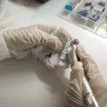 Treviso, mandibola ricostruita in 3D su una paziente di 17 anni